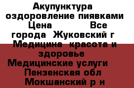 Акупунктура, оздоровление пиявками › Цена ­ 3 000 - Все города, Жуковский г. Медицина, красота и здоровье » Медицинские услуги   . Пензенская обл.,Мокшанский р-н